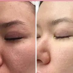 Vergleich: Haut mit großen Poren vor und nach der Anwendung von Retinol. Die Haut wirkt feiner und ebenmäßiger.
