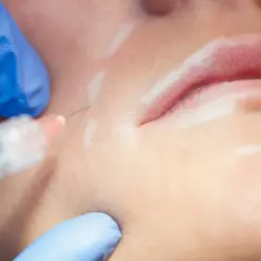 Nahaufnahme einer Lippenunterspritzung mit Hyaluronsäure. Die Frage, ob Hyaluron krebserregend ist, beschäftigt viele.