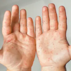 Hautausschlag an den Händen, möglicherweise durch eine Vitamin C-Allergie verursacht. Rote Flecken auf der Haut.