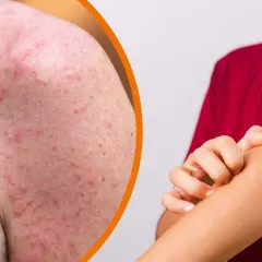 Gerötete Haut mit vielen kleinen Pickeln, die auf Sonnenbrand hindeuten. Eine Hand kratzt sich am Arm.
