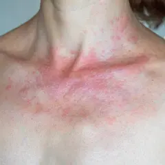Rote, juckende Haut am Dekolleté und Hals, ein Zeichen für Sonnenallergie. Vorbeugen ist wichtig.