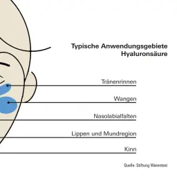 Typische Anwendungsgebiete von Hyaluronsäure im Gesicht: Tränenrinnen, Wangen, Nasolabialfalten, Lippen, Mundregion, Kinn. Die Hyaluron Wirkung ist hier visuell dargestellt.