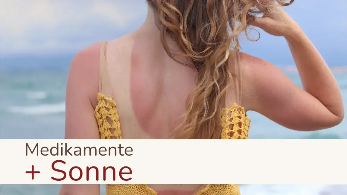 Sonnenbrand am Rücken einer Frau, die Medikamente einnimmt. Vorsicht bei Antibiotika und Sonne!