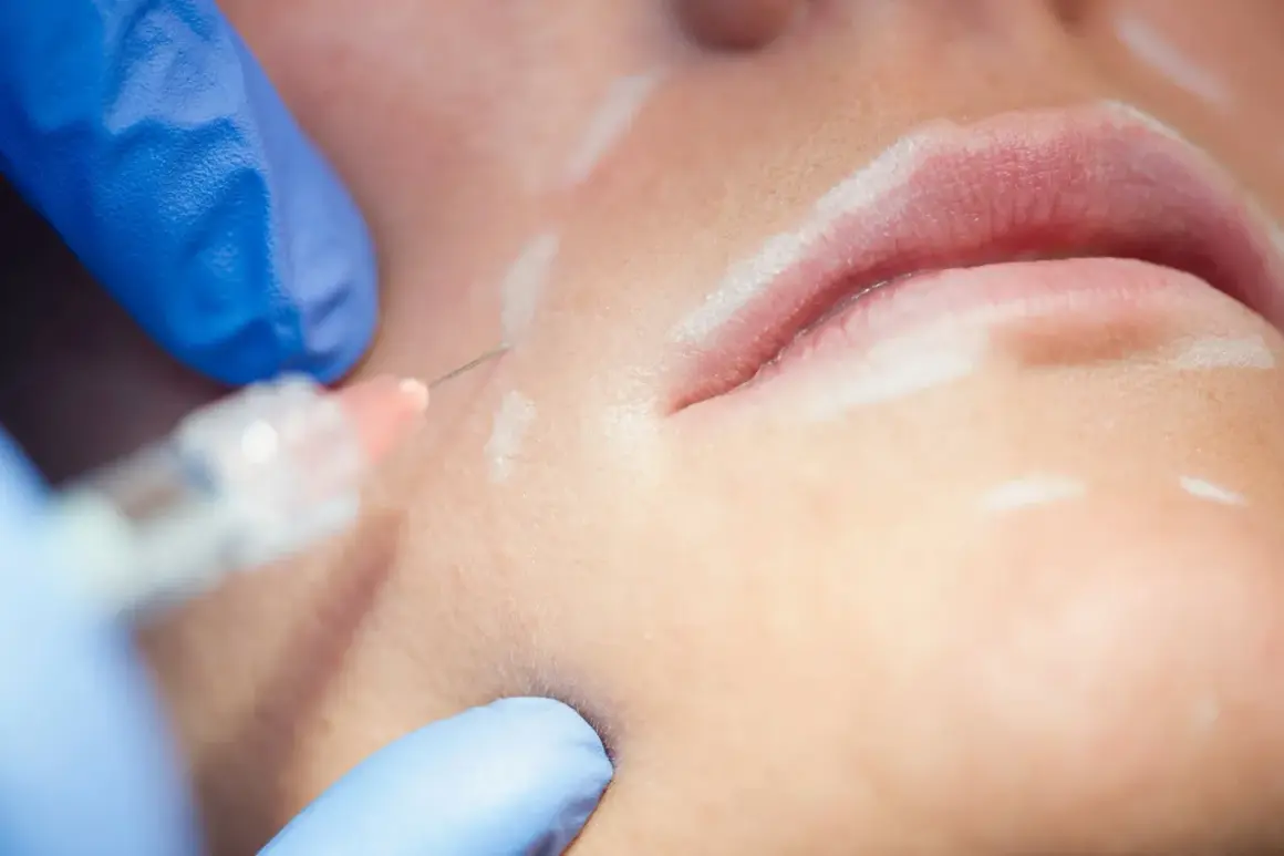 Nahaufnahme einer Lippenunterspritzung mit Hyaluronsäure. Die Frage, ob Hyaluron krebserregend ist, beschäftigt viele.