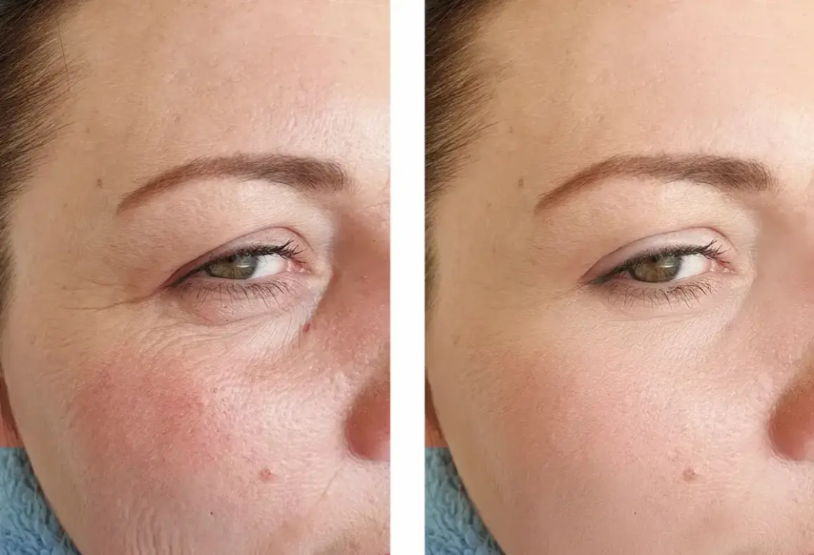 Vorher-Nachher-Vergleich: Deutliche Reduzierung von Falten und Rötungen durch Retinol Hautpflege.