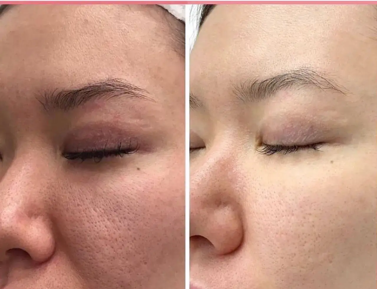 Vergleich: Haut mit großen Poren links, verfeinerte Poren rechts. Deutliche Verbesserung nach Anwendung von Retinol.
