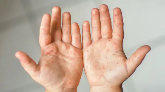 Vitamin C-Allergie Hautausschlag - Allergie oder Reizung erkennen?